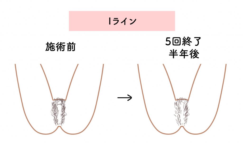 アリシアクリニックVIO脱毛5回の効果（Iライン）