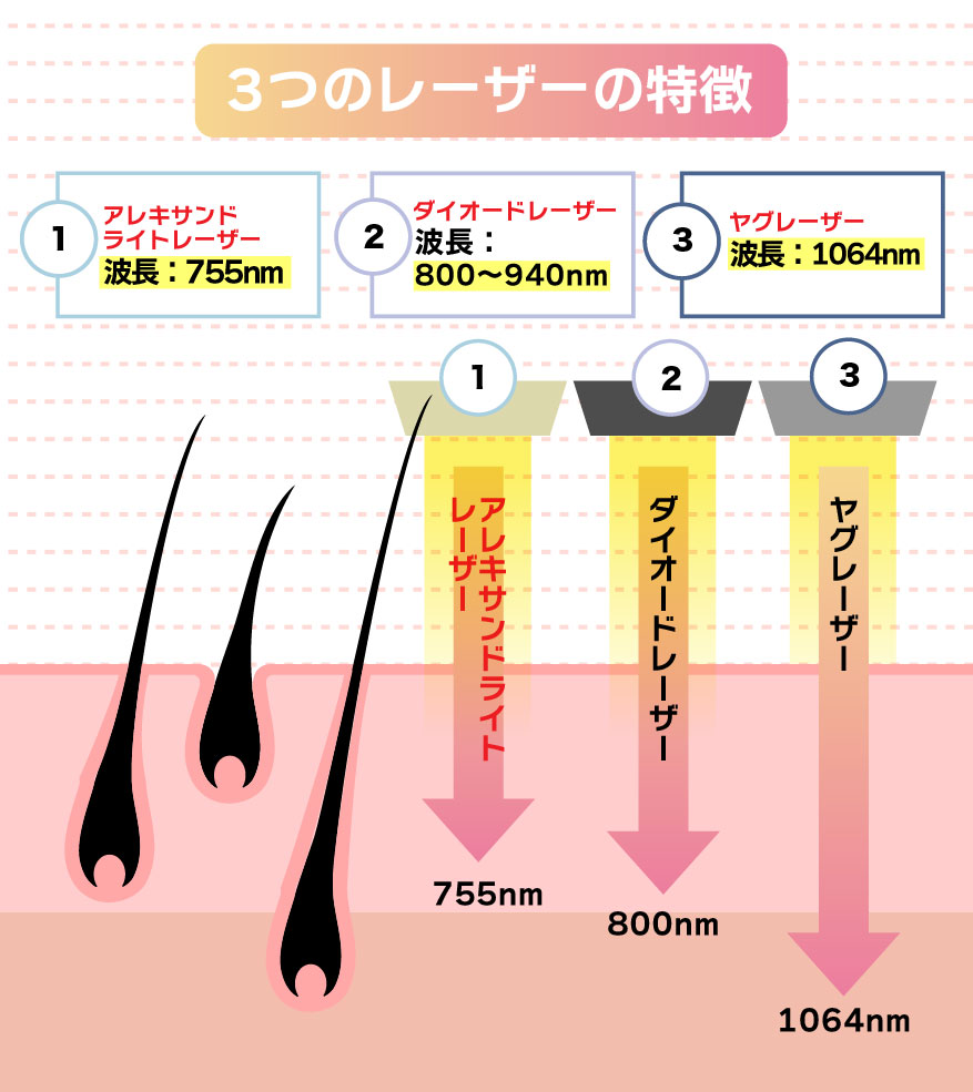 医療脱毛の３つのレーザー